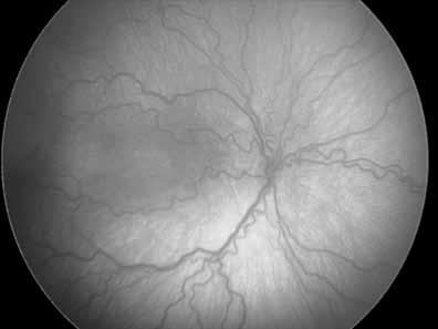 REÑONES J, et al. Fig. 1: Fondo de ojo derecho del caso 1 antes del tratamiento, ROP estadio 3 plus en zona I. Fig. 2: Fondo de ojo derecho del caso 1 dos semanas después del tratamiento con láser y bevacizumab.