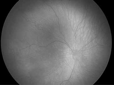 Se da en recién nacidos prematuros en los que aún no se ha completado el desarrollo distal de los vasos retinianos, de modo que en el momento del nacimiento la retina periférica todavía no está