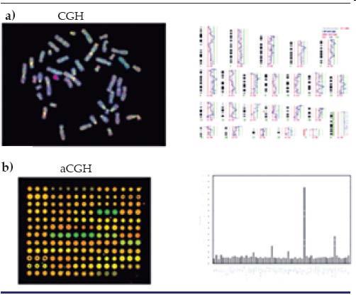 CGH La hibridación genómica comparativa empleando arrays.