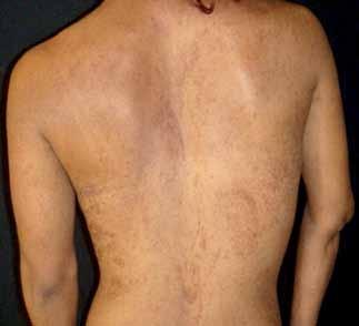 La dermatosis era bilateral y simétrica; estaba constituida por múltiples manchas hiperpigmentadas de diversas formas y tamaños y límites bien definidos, dispuestas en líneas y remolinos a lo largo