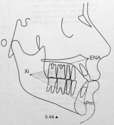 Fig. 12: Altura facial Inferior (Azenha, 2008) Plano mandibular.
