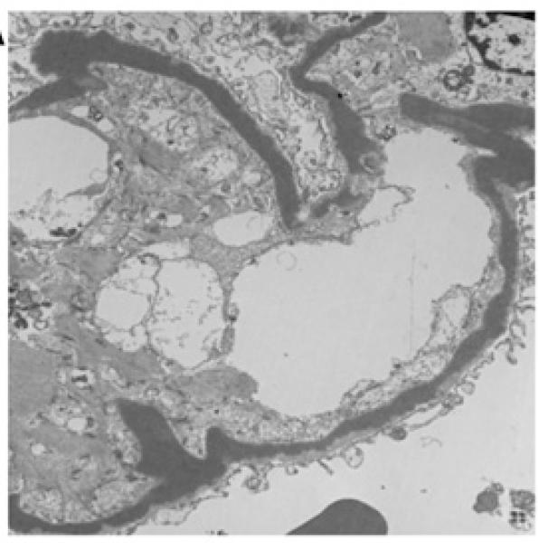 Glomérulopatía C3 Microscopía electrónica Enfermedad por