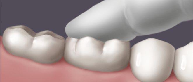 Guía técnica de Calibra Universal 1 LIMPIAR Y SECAR Siga las instrucciones del laboratorio dental o del fabricante para el acondicionamiento de la cara