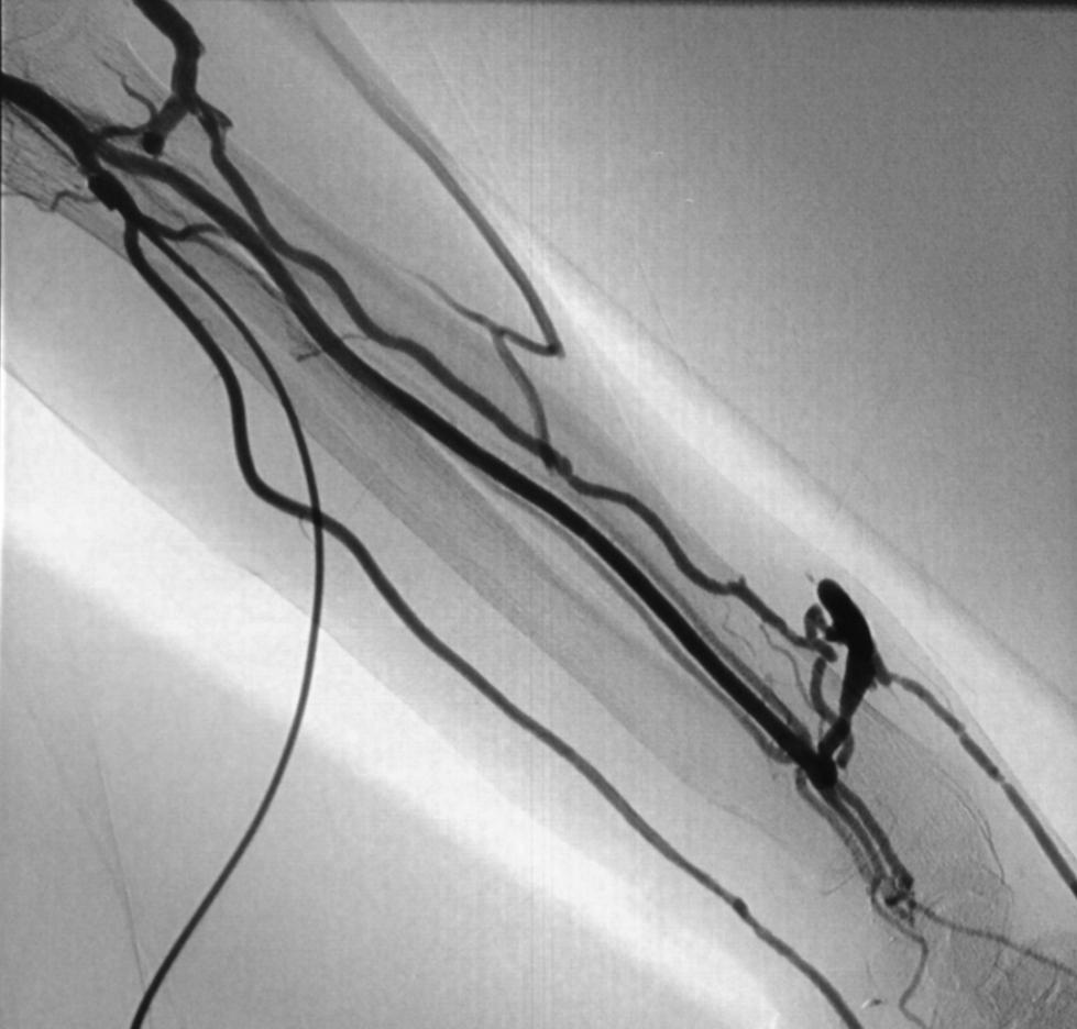TIPO DE ABORDAJE: FAV RADIO-CEFÁLICA * arteria humeral retrógrada - Ventajas. adecuada visualización de la anastomosis,.