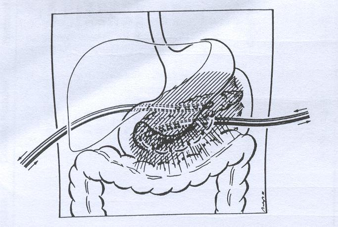 Cuál es la técnica quirúrgica más adecuada TÉCNICA Necrosectomía + lavados+cierre celda pancreática Beger Hg,Buchler M, Bittnner R, et al.