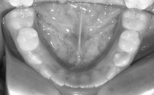 El máximo efecto de la terapia con bite-blocks se lograría por la intrusión simultánea de los dientes posteriores y un aumento del