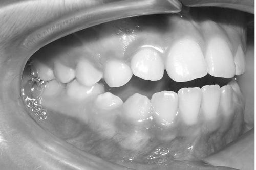 Presentación del Caso Clínico Paciente femenino, 8 años, dentición mixta 1ra fase, clase I esqueletal, dolicofacial, neutroclusión molar,