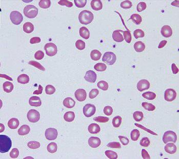 Cambios en los glóbulos rojos Cómo funciona la hydroxyurea? La hydroxyurea hace que los glóbulos rojos sean más grandes y menos propensos a volverse falciformes.