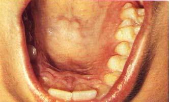 Mucosa palatina.