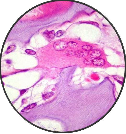 Osteoclasto Ocl Los osteoclastos son células gigantes, irregulares, citoplasma acidófilo, multinuclear (figura 1.11 y 1.