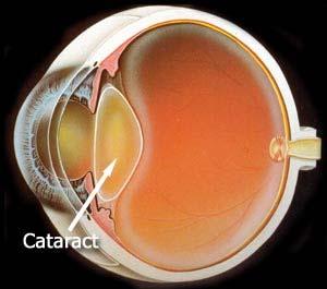 Cataratas Las Cataratas son una opacificación del cristalino que impide que la luz llegue a la retina provocando disminución progresiva de la visión hasta la ceguera.