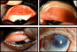 Tracoma Enfermedad ocular infecciosa a nivel de conjuntiva tarsal (folículos en el interior del párpado). Causada por la bacteria denominada Chlamydia trachomatis.