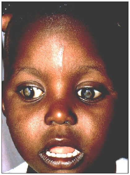 Ceguera Infantil Hay 1.5 millones de niños ciegos en el mundo. (Asia 1M, África 0.3 M) 5 millones de niños tienen deficiencias visuales graves.