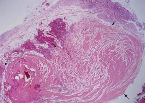 Foto 4: Histopatología de