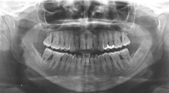 Ortopantomografia (OPG) Ventajas: Visión General Ambos maxilares Altura maxilares Limitaciones: Poca claridad