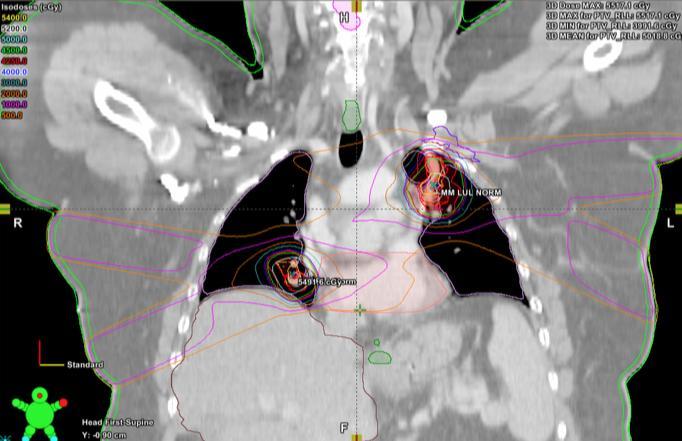 Múltiples sitios Oligo-metástasis pulmonares: SBRT 45 Gy/5Fx a lesión Derecha 40 Gy/5 Fx a lesión Izquierda Siempre realizar un plan suma si se