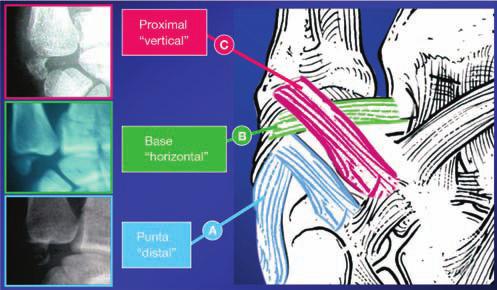 22 J.M. Rotella y P. Rotella tos cubito-carpianos. Figura 3 Patrón de lesión del sector radial. Compromiso de la cortical Interna. - cantidad de - zamientos de los otros sectores.