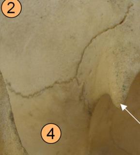b) Sutura Escamosa: Aquí los bordes se encuentran cortados en bisel, por lo cual uno de los huesos cubre parte del otro.