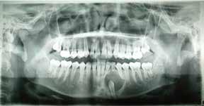 Figura 2 Aspecto intraoral de la zona y distal de los dientes 34 y 32, respectivamente, con desplazamiento divergente de las raíces de estos en ese mismo sentido.