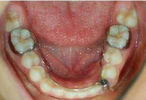 El diagnóstico definitivo fue tumor odontogénico adenomatoide (figura 6).
