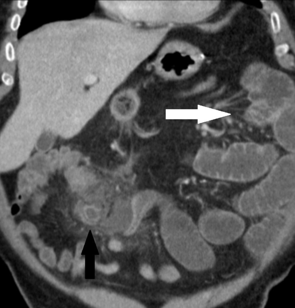 Fig. 4: TC de abdomen con contraste IV. MPR Coronal.