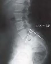 Parámetros lumbares: Lordosis lumbar Vértebra trapezoidal Angulo lumbo sacro Angulo inclinación sacra Grado