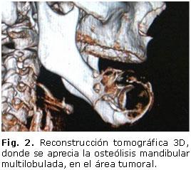 Como resultado de una biopsia incisional el informe del estudio histopatológico reveló la presencia de un carcinoma odontogénico de células claras (Fig. 3).