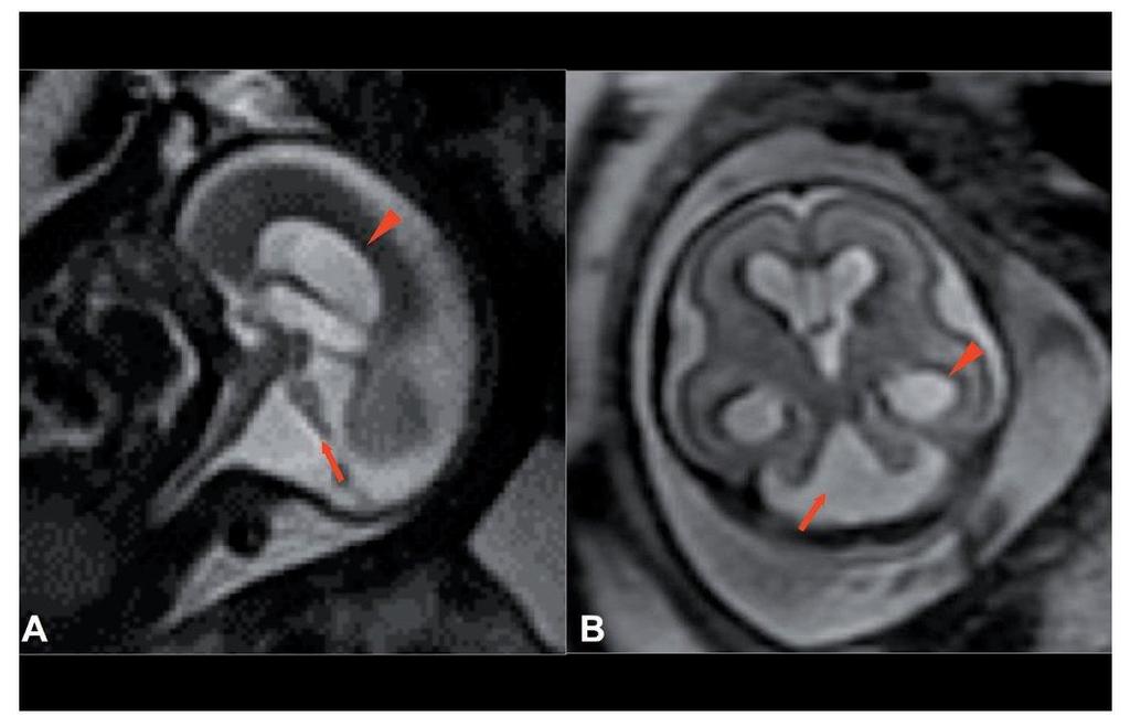 RNM cerebral fetal Especialmente útil en OHA y pacientes obesas.