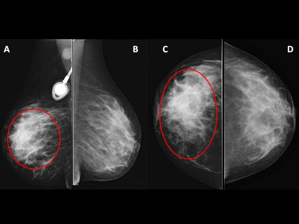 Fig. : Mamografías(A-D Asimetría de densidad en CSE- región