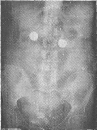 Creemos que el uso de plicaduras intestinales o mesentéricas está contraindicado en los casos de peritonitis masiva generalizada, pero puede usarse en los casos de peritonitis localizada. Fig. No. 1.