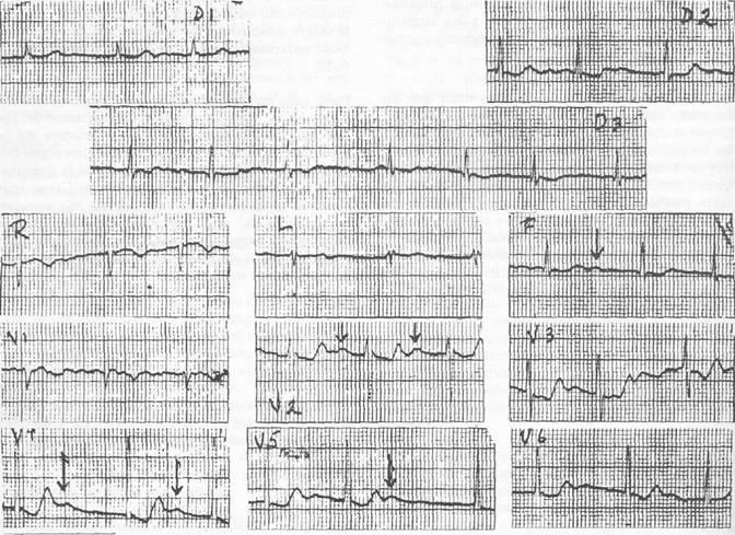 EDUCACIÓN MEDICA CONTINUA ELECTROCARDIOGRAFÍA PRACTICA Dr. Marco A. Bográn Observe el Electrocardiograma ilustrado, el ritmo es irregular, frecuencia cardiaca variable alrededor de 65, QRS de 0.