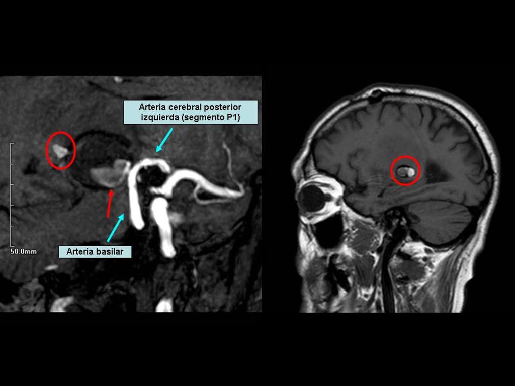 Fig. 24: Angio-RM cerebral (imagen izquierda) que muestra la exclusión ineficaz del aneurisma (flecha roja; flujo dentro del aneurisma) pese al tratamiento con stent diversor de flujo endovascular.