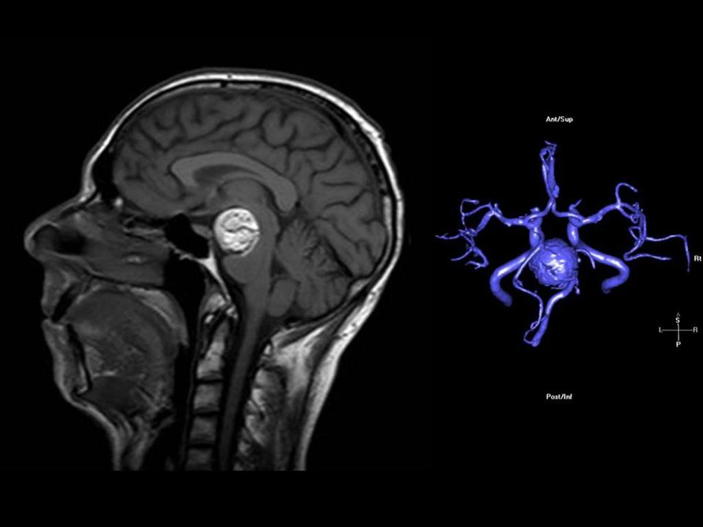 Fig. 35: Secuencia sagital T1 y reconstrucción volumétrica 3D del aneurisma y arterias cerebrales.