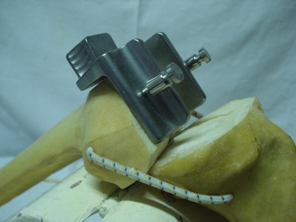 El sistema AFI centra la guía intercondilar para que coincida el centro del componente femoral (cajón protésico) con la cresta tibial del liner tibial.