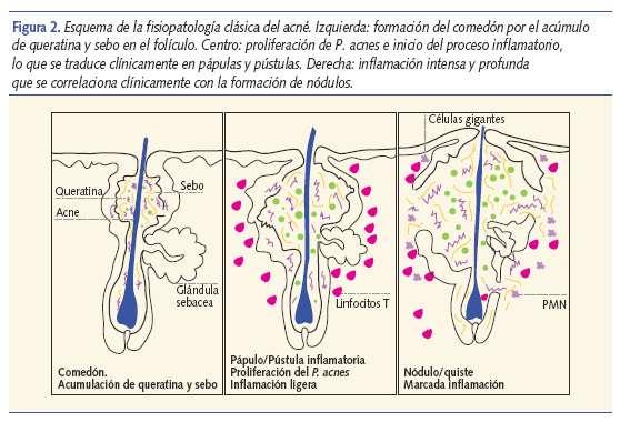 Fisiopatología: Al llegar a la pubertad ocurre un cambio endocrinológico, se aumenta la producción de hormonas sexuales que tiene la capacidad de estimular a las glándulas sebáceas.
