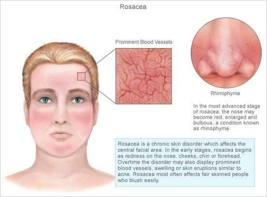 ROSÁCEA Definición: Enfermedad crónica inflamatoria de predominio facial, caracterizado por pequeñas y superficiales dilataciones de vasos capilares (telangiectasias).