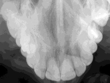 Radiografías intraorales Radiografía oclusal de maxilar superior Radiografías dentales