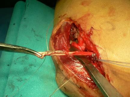 Lateral elbow reconstruction using a new fixation technique. Arthroscopy. 2005 Apr;21(4):503-5. 7. Mehta JA, Bain GI. Posterolateral rotatory instability of the elbow. J Am Acad Orthop Surg.