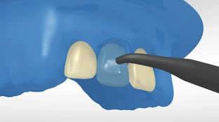 5 La restauración es pre-tratada y se aplica el adhesivo Primero se aplica N-Etch (ácido fosfórico en gel al 37%) al esmalte o dentina preparada (de ser necesario).