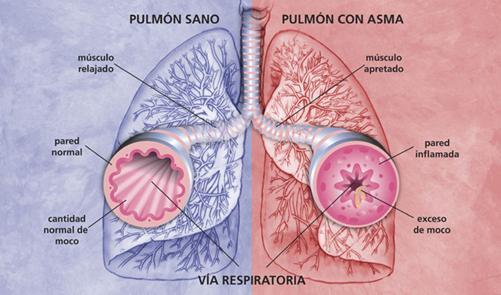 Flujo Pico Espiratorio En niños con asma ha sido propuesto con