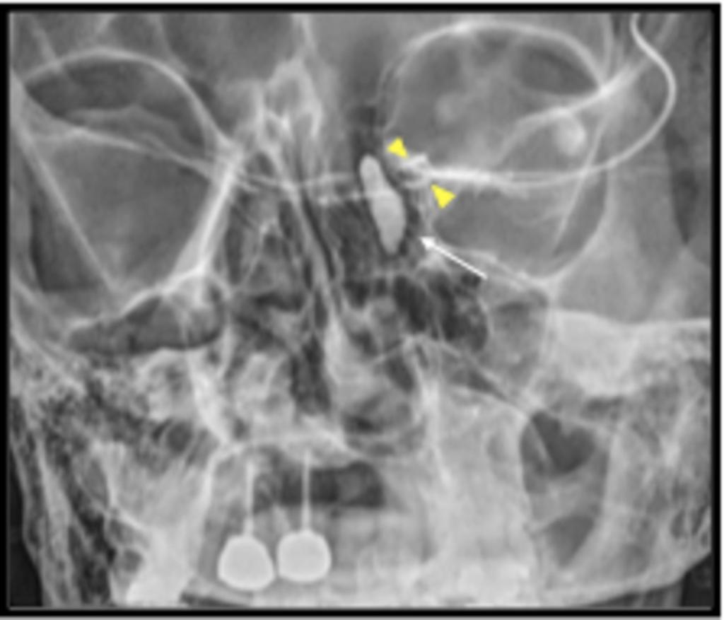 Fig. 8: Distensión de los canalículos (cabezas de flecha amarillas) y del