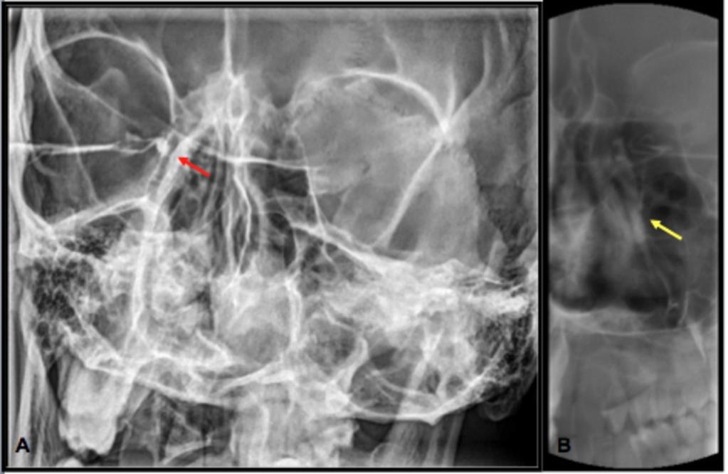 Fig. 5: A. Obstrucción congénita de OD (estudio precirugía); nótese el stop de contraste y la dilatación del canalículo común (flecha roja).
