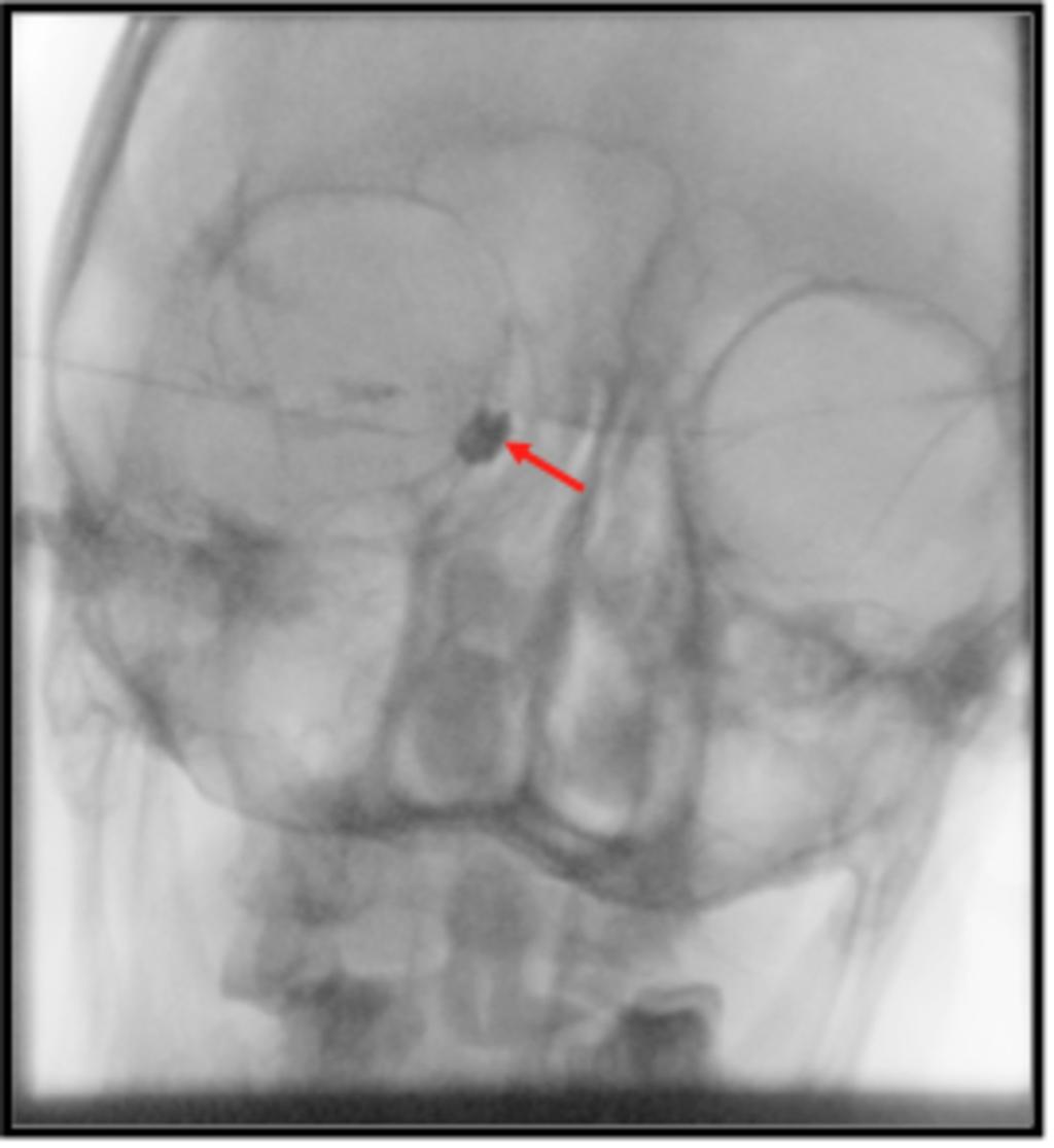 Fig. 6: Dilatación del saco lagrimal (flecha roja) sin visualizarse paso del