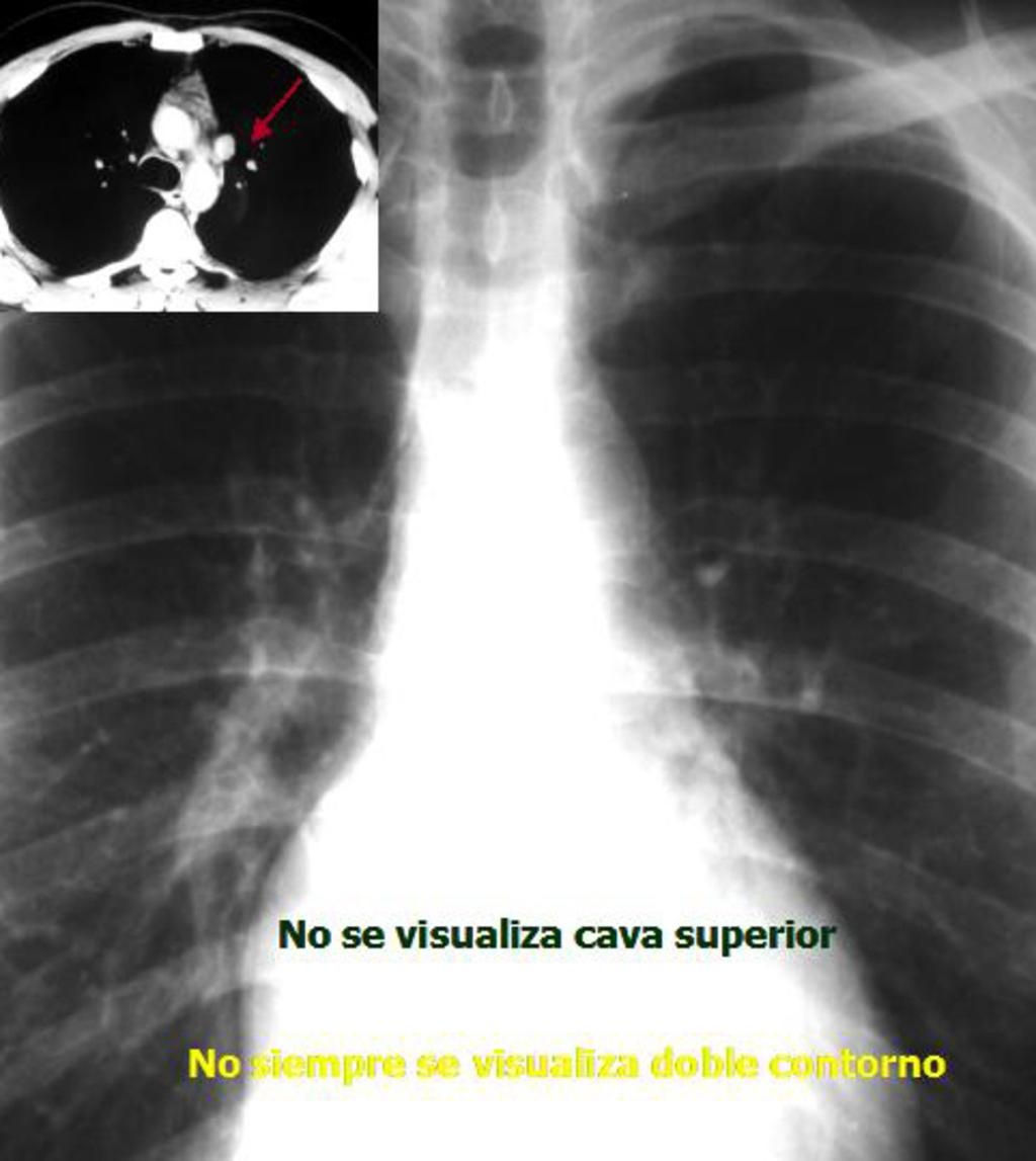 Fig. 8: Paciente con vena cava superior I visible en TC con contraste (flecha roja).