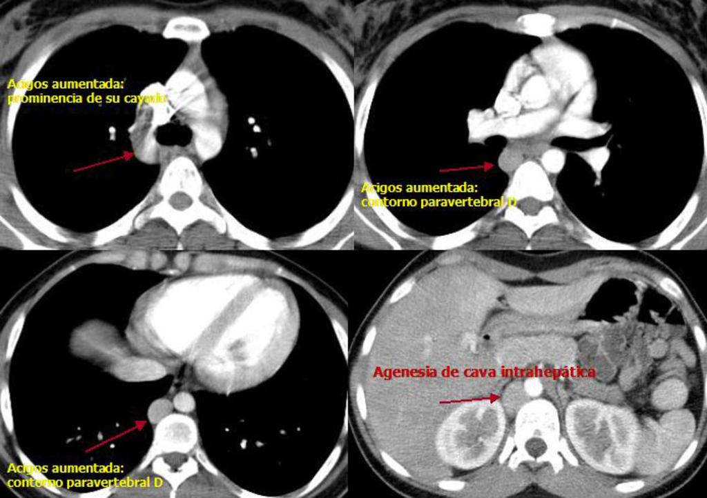 Fig. 15: Estudio de TC con contraste de paciente mostrado en Fig. 13. cortes axiales de tórax y abdomen superior.