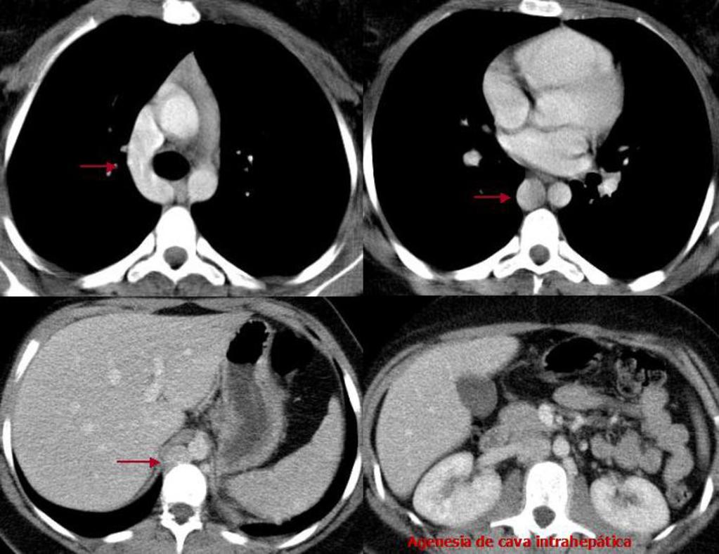 Fig. 16: Estudio de TC con contraste en paciente mostrado en Fig. 14: cortes axiales de tórax y abdomen superior.