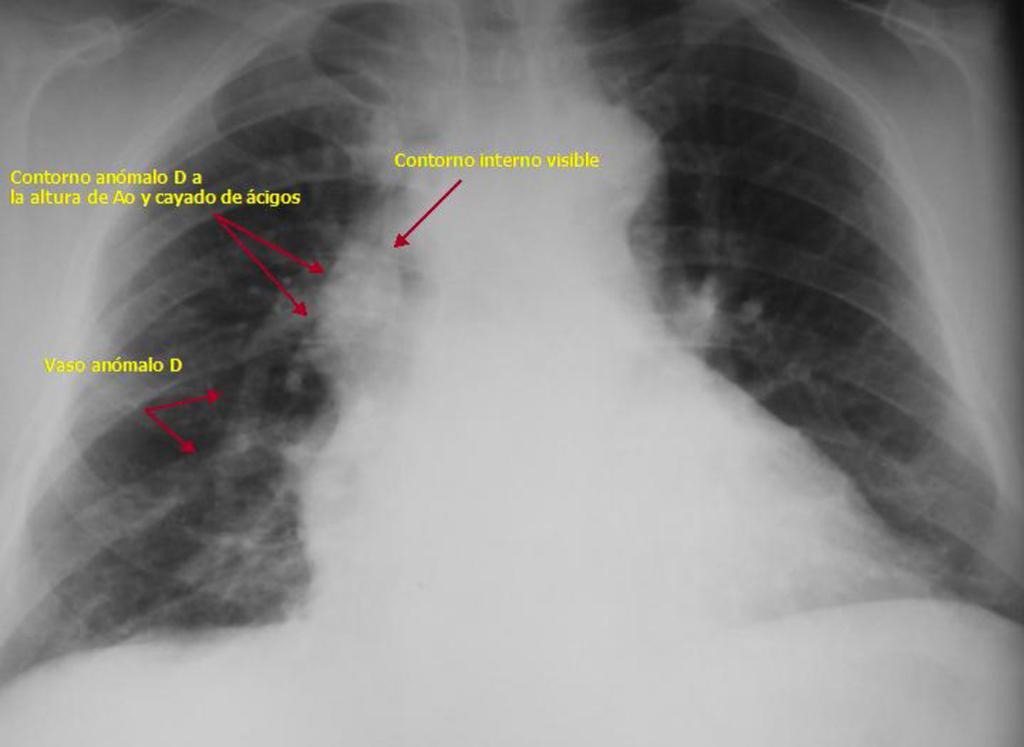 Fig. 22: Proyección PA de paciente con drenaje venoso pulmonar anómalo combinado del LM y del LSD a