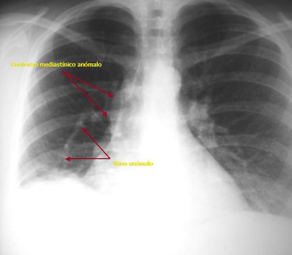 Fig. 23: : Proyección PA de paciente con drenaje venoso pulmonar anómalo combinado del LM