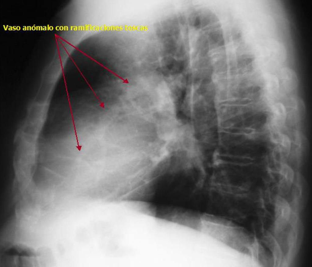 Fig. 24: Proyección lateral de tórax del paciente mostrado en la Fig.