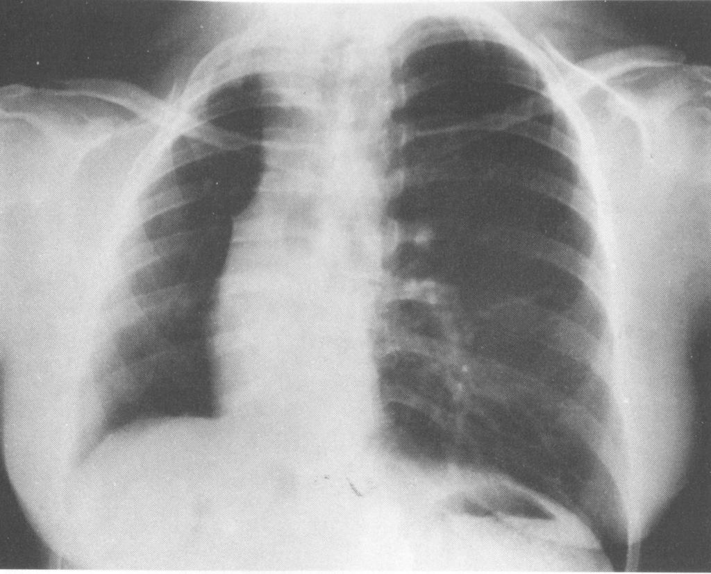 Fig. 36: Pérdida de volumen del pulmón derecho con oligohemia.